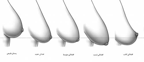 عوارض نبستن سوتین، علت افتادگی سینه ها، فرم دادن به سینه، عوارض سوتین اسفنجی،  عوارض بستن سوتین هنگام خواب،  نبستن سوتین ،  عوارض سوتین فنردار،  فوايد سينه بند ، سوتین چیست،  بستن سوتین هنگام ورزش،  بهترین نوع سوتین